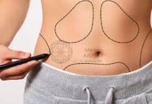 Liposuction in Dubai
