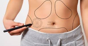 Liposuction in Dubai